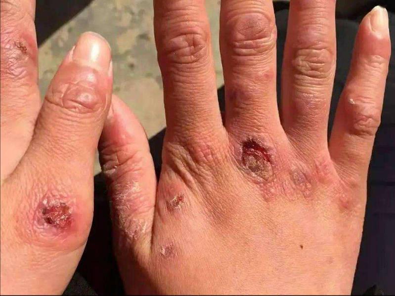 根治凍瘡,預防復發,全面解析凍瘡的治療方法,根治凍瘡,預防復發,全面解析凍瘡治療策略