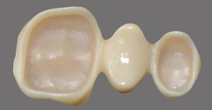 烤瓷牙和全瓷牙的利與弊,深度解析,深度解析,烤瓷牙與全瓷牙的優缺點對比