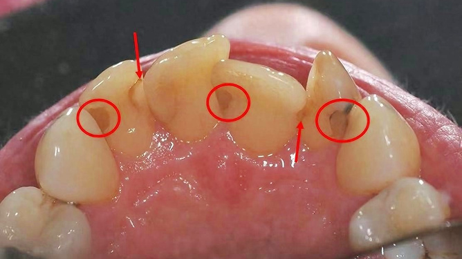 牙結石怎么去除小竅門,牙結石去除小妙招分享