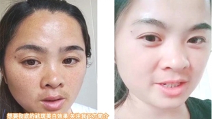 黃褐斑最好的方法,目前最有效的解決方案,黃褐斑最有效的解決方案,最新方法與策略