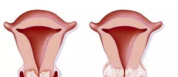 女性HPV初期感染的圖片及其相關知識科普，女性HPV初期感染圖片與知識科普，了解、預防與治療