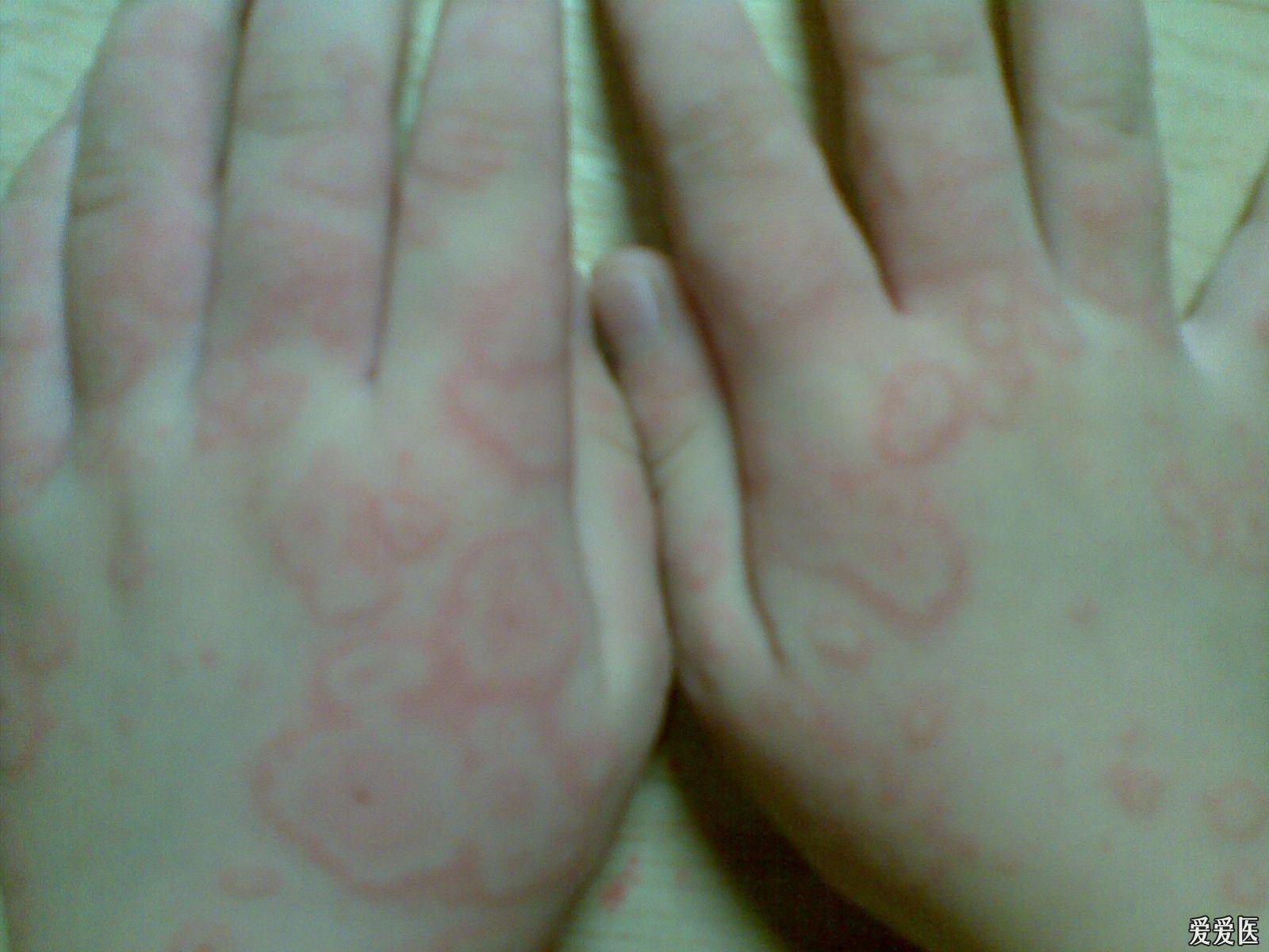 關于螨蟲過敏圖片與澳彩資料的查詢,來自94848.cσm的詳盡資源,螨蟲過敏圖片與澳彩資料查詢,詳盡資源來自94848.cσm