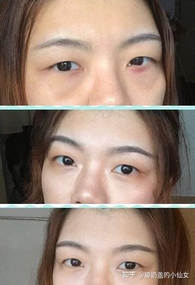 眼袋切除手術費用詳解,價格因素與如何選擇合適的手術方案,眼袋切除手術費用解析,了解價格因素與選擇最佳手術方案