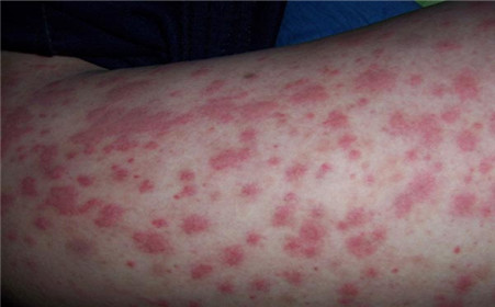 過(guò)敏性紫癜能自愈嗎？解析疾病真相與應(yīng)對(duì)之策，過(guò)敏性紫癜解析，能否自愈？真相與應(yīng)對(duì)策略探討