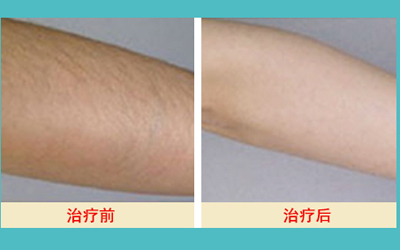 激光脫毛的價格解析,多少錢才能擁有絲滑肌膚?,激光脫毛價格詳解,多少錢能擁有絲滑肌膚?