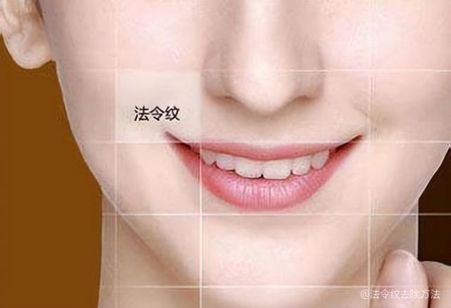 如何去除法令紋——打造青春無痕肌膚，如何消除法令紋，重塑青春無瑕肌膚