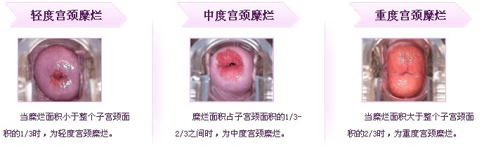 宮頸糜爛的癥狀及其影響,了解、預防與治療,宮頸糜爛的癥狀、影響、預防與治療全解析