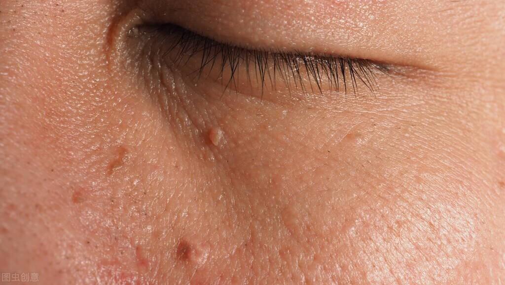 一圖教你識別皮贅和疣，兩者的區別與診斷方法，皮贅與疣的識別指南，圖解區別與診斷方法