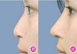 整鼻子的費用詳解，你需要知道多少錢？，整鼻子費用全解析，你需要知道多少？