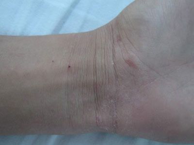 疥瘡圖片和癥狀，全面了解疥瘡，助力健康防護(hù)，全面了解疥瘡，癥狀與圖片解析，助力健康防護(hù)