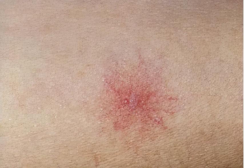 掃一掃查皮膚病圖片，了解皮膚健康的便捷途徑，掃一掃即知，皮膚病圖片解析，輕松掌握皮膚健康之道