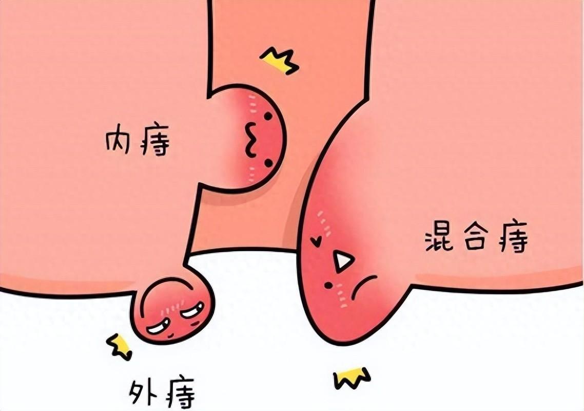 痔瘡成因解析,為何我們會遭遇這一尷尬病癥?,痔瘡成因深度解析,為何會遭遇這一尷尬病癥?