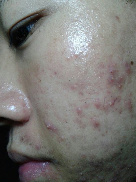 臉上痤瘡圖片，了解、預防與治療，臉上痤瘡詳解，圖片展示、預防與治療方法