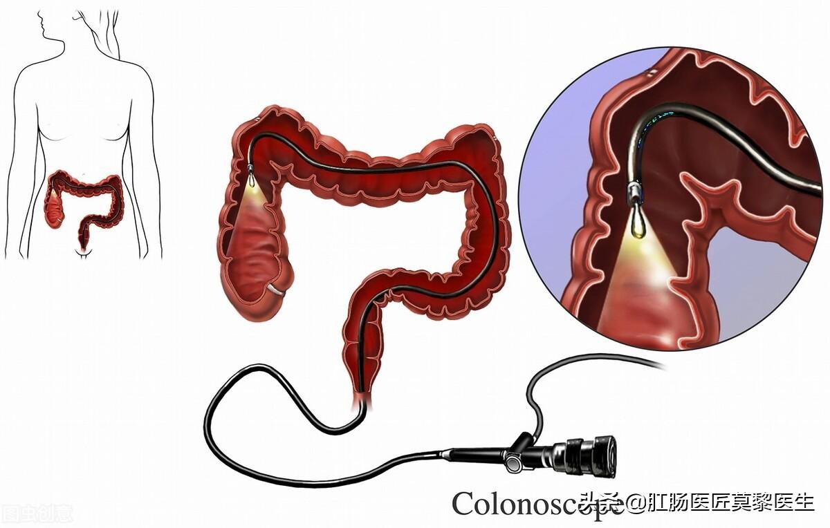 腸息肉最佳治療方法，全面解析與選擇，腸息肉最佳治療方法詳解與選擇策略